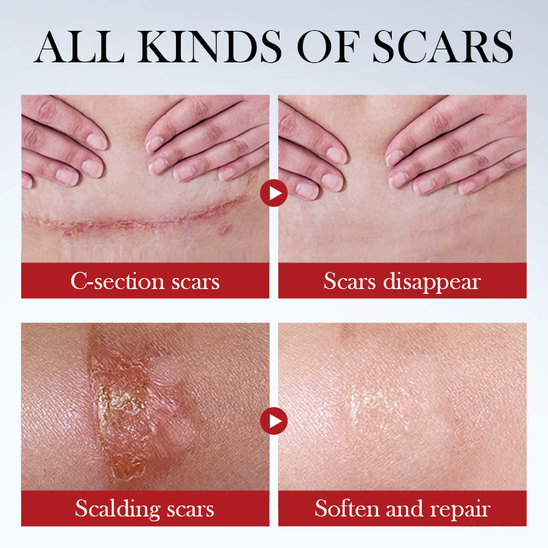 SADOER Scar Repair Cream - ( BUY 1 GET 1 FREE )