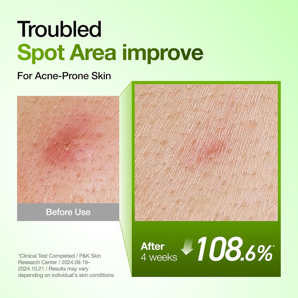 Anua Azelaic Acid 10 Hyaluron Redness Soothing Serum -  Facial Serum for Blemish-Prone & Oily-Prone Skin, Lightweight & Hydrating Blemish Care, Hyaluronic Acid - 30 ml